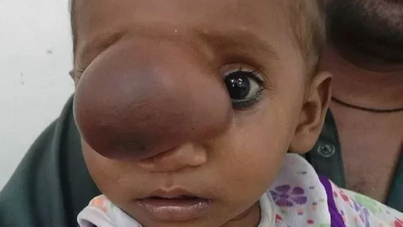 ولادة طفل باكستاني بمخ في وجهه