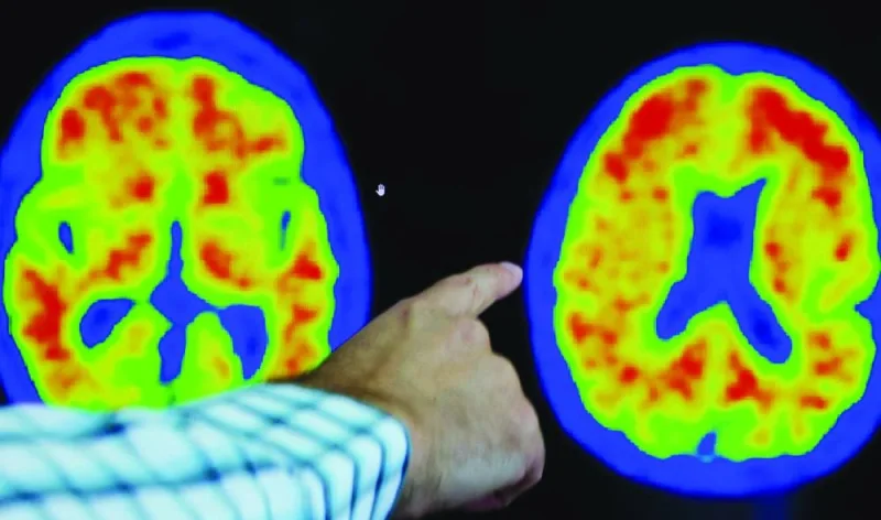 
Dr Seth Gale points out evidence of Alzheimer’s disease on PET scans at the Center for Alzheimer Research and Treatment (CART) at Brigham And Women’s Hospital in Boston. 