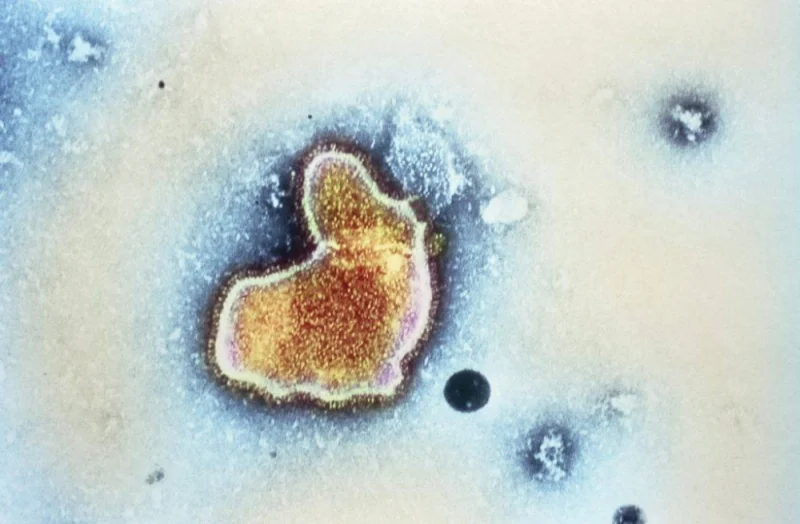 Respiratory syncytial virus. Coloured transmission electron micrograph (TEM) of a respiratory syncytial virus (RSV). This pneumovirus, a type of paramyxovirus, is a major cause of human respirat- ory tract infections in temperate climates, especially in winter. The virus consists of RNA (ribonucleic acid) genetic material enclosed in a protein coat, or capsid, within a phospholipid envelope. The envelope is covered in protein spikes, seen as the yellow lines around the edge of the virus. In adults, the virus only affects the upper respiratory tract, but in infants bronchiolitis (bronchiole inflammation) or bron- chopneumonia can result. Magnification unknown.