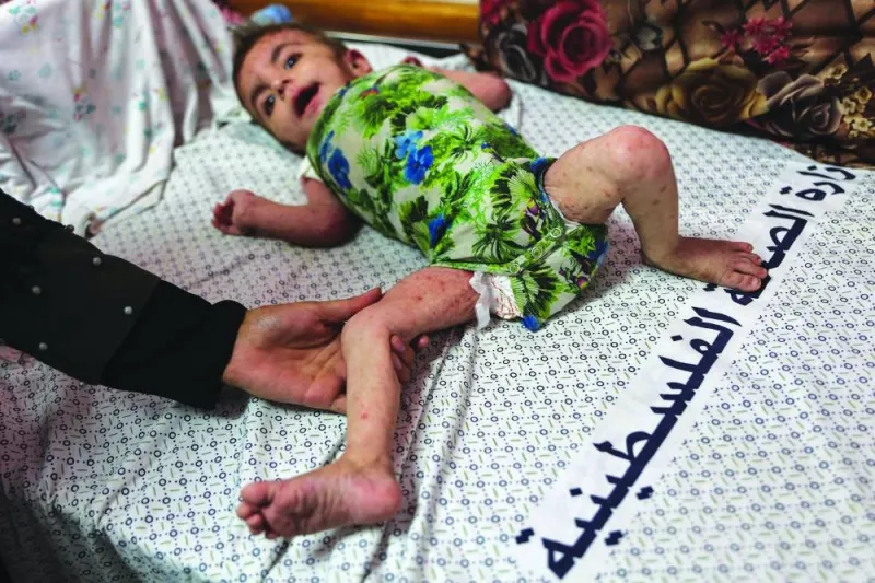 Palestinian baby girl Wateen al-Adasi who developed a skin condition due to malnutrition rests at the Kamal Adwan hospital in Beit Lahia in the northern Gaza Strip. 
