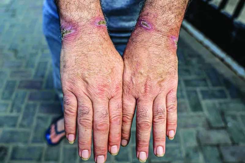 
File photo shows a man who was detained with other Palestinians by the Israeli military during their operation in the northern Gaza Strip and recently released, showing off the injuries on his wrists at 
Al-Najjar hospital in Rafah in the southern Gaza Strip. 