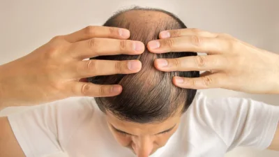 دراسة تثبت فاعلية الحمض النووي في علاج تساقط الشعر