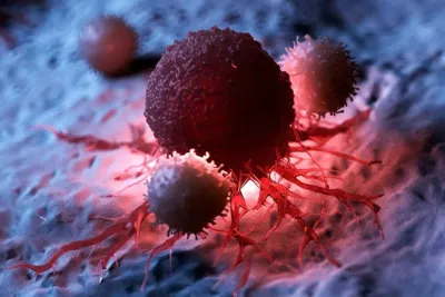  10 أنواع من السرطان تُشكل ثلثي الحالات الجديدة