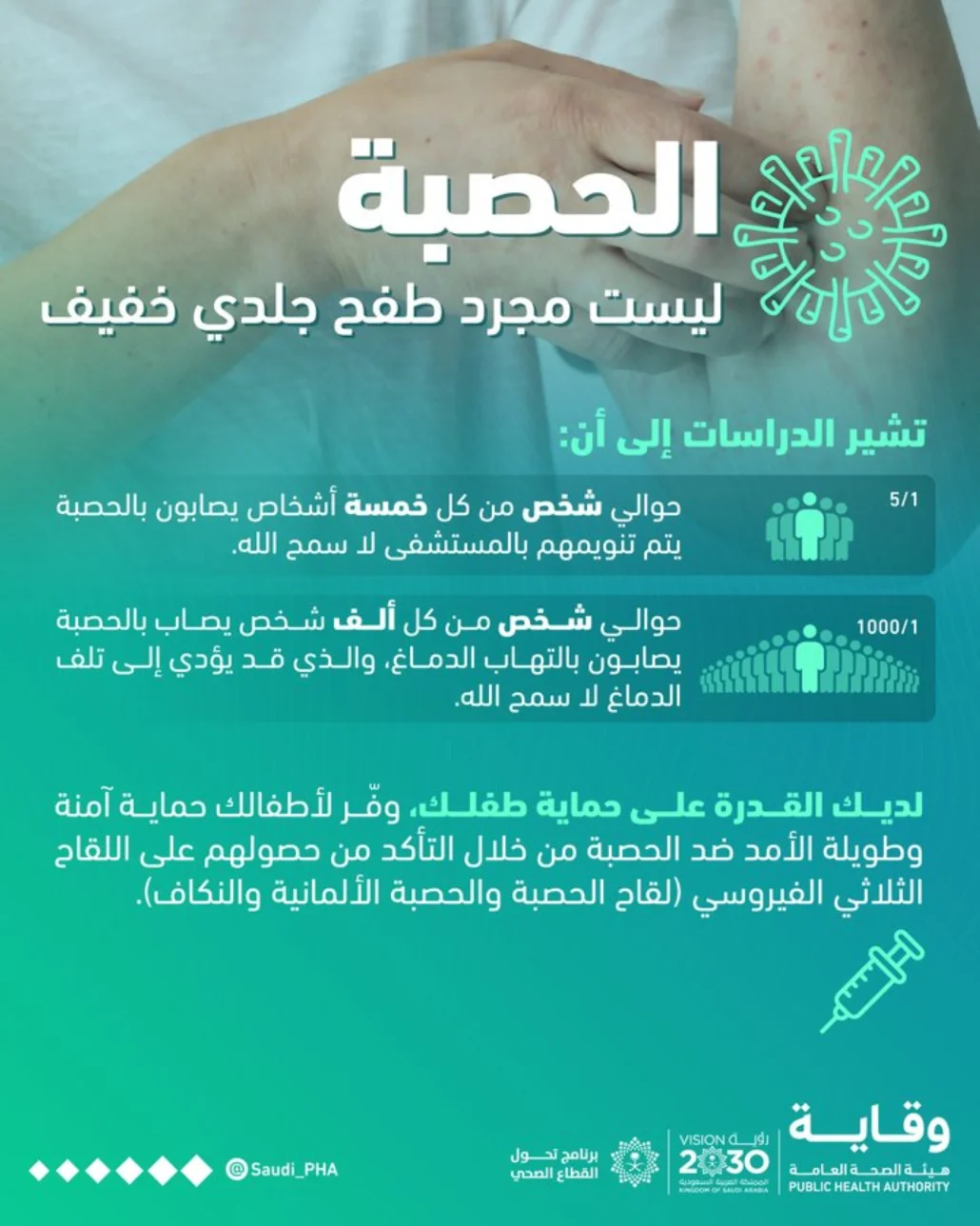 300 ألف إصابة بالحصبة في عام 2023