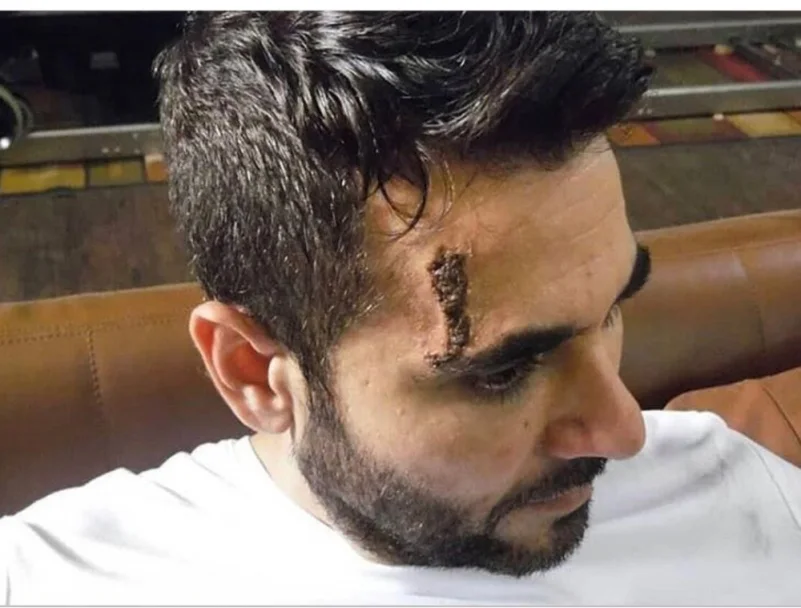 إصابة أحمد عز أثناء تصوير «الممر»