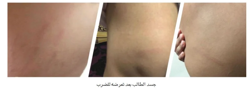 شرطة جدة تحقق في اعتداء معلم على طالب بالضرب المبرح