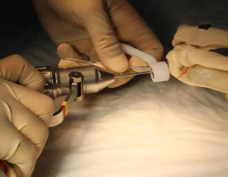 جراح سعودي يبتكر جهازًا لتثبيت الكسور في دقائق