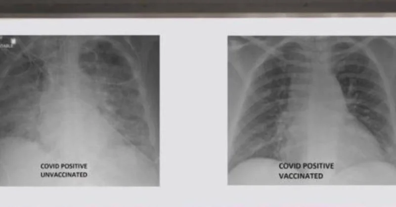 صور أشعة تكشف تدمير "كورونا" لرئتي غير المحصنين