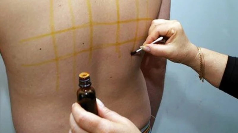 تبديد الشائعة طبيبة: لا صحة لـ»شبكة اليود»على الجلد
