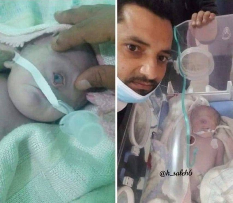 ولادة طفل يمني بـ"عين واحدة" في حالة نادرة.. والكشف عن مصيره - صورة