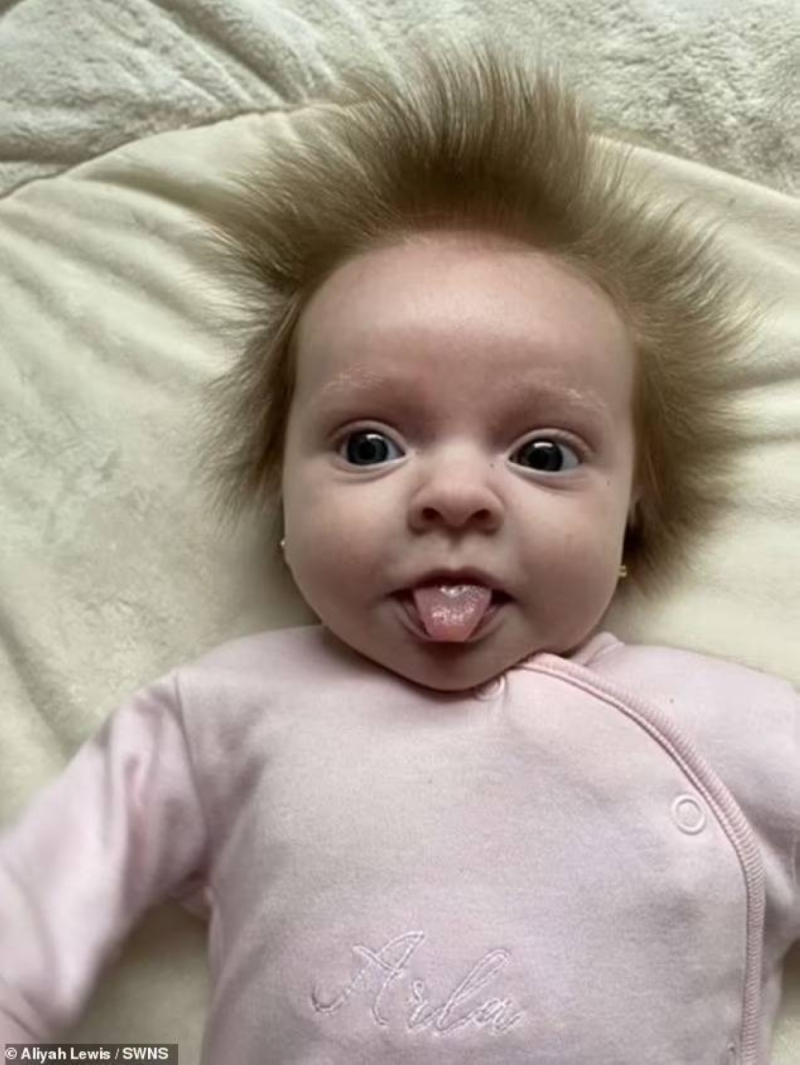 "لا يمكن تسريحه".. شاهد : الطفلة "القنفذ" ينمو شعرها بطريقة غريبة