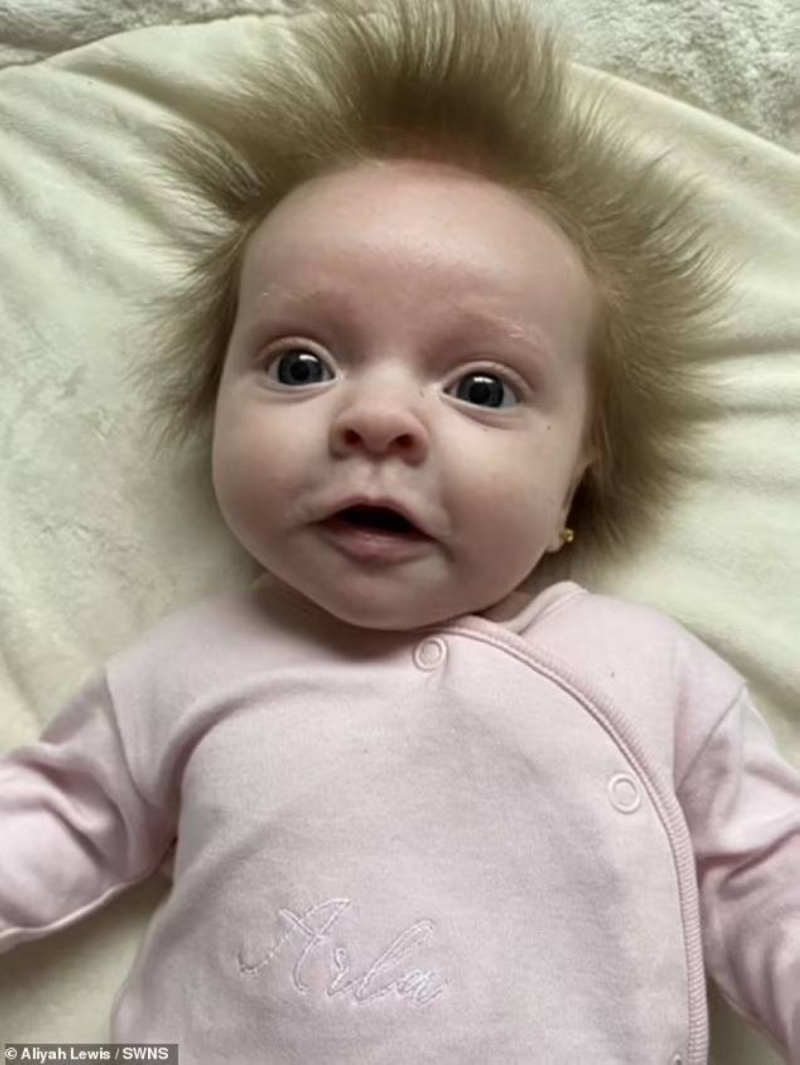 "لا يمكن تسريحه".. شاهد : الطفلة "القنفذ" ينمو شعرها بطريقة غريبة