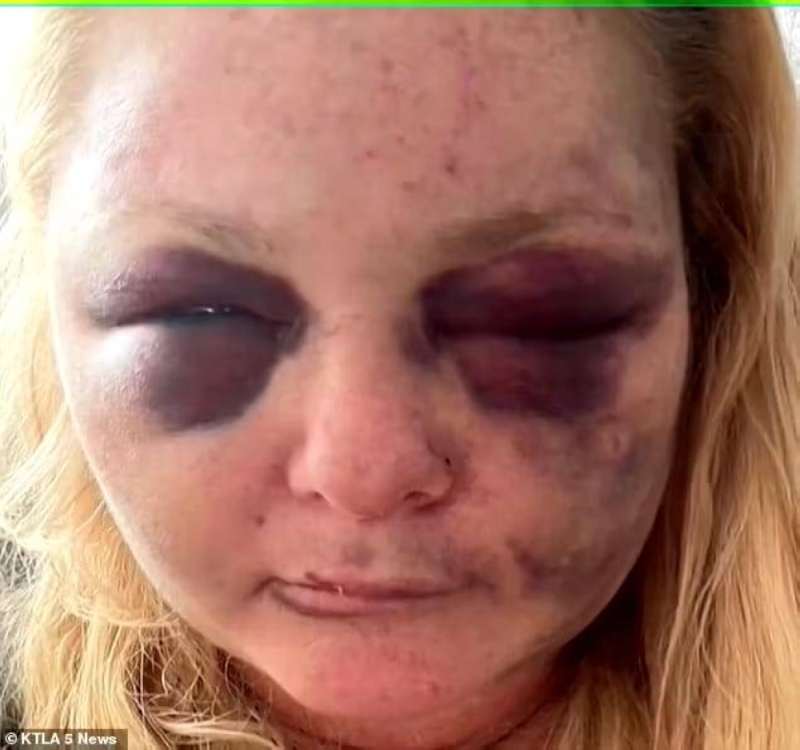 "أثناء خروجها لتمشية كلابها"...  اغتصاب أمريكية وتهشيم وجهها في كاليفورنيا - فيديو وصور