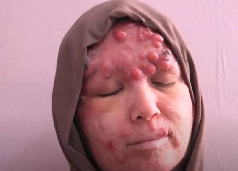شاهد صور صادمة لفتاة جزائرية مصابة بمرض نادر في الوجه