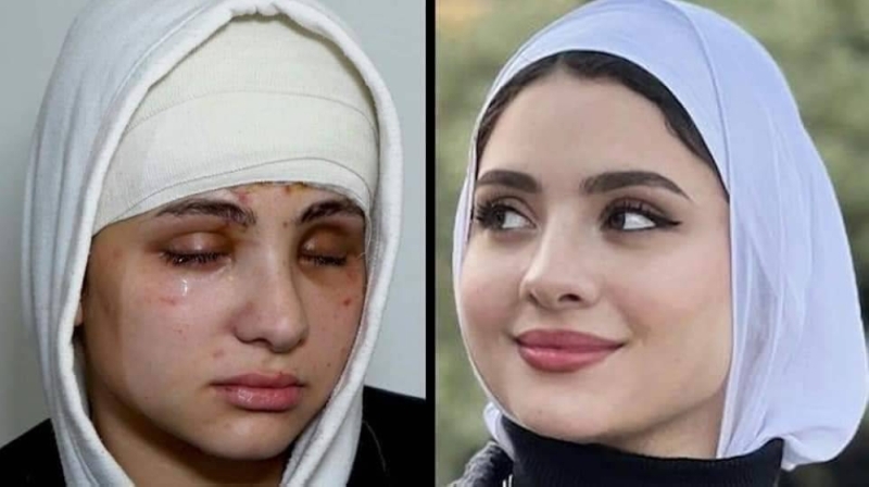الأطباء يصدمون البلوغر المصرية الحسناء التي تعرضت لهجوم مسلح بعد العملية الجراحية في عينيها - صور