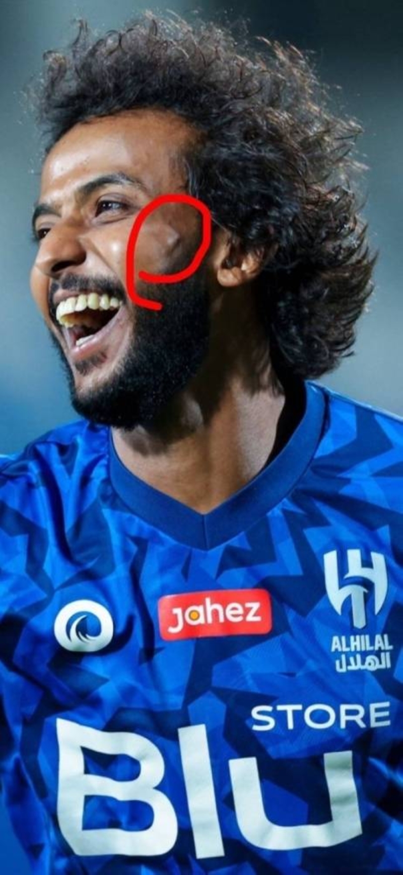 شاهد.. ظهور علامة "نتوء" في وجه لاعب الهلال " ياسر الشهراني" تُثير التساؤلات