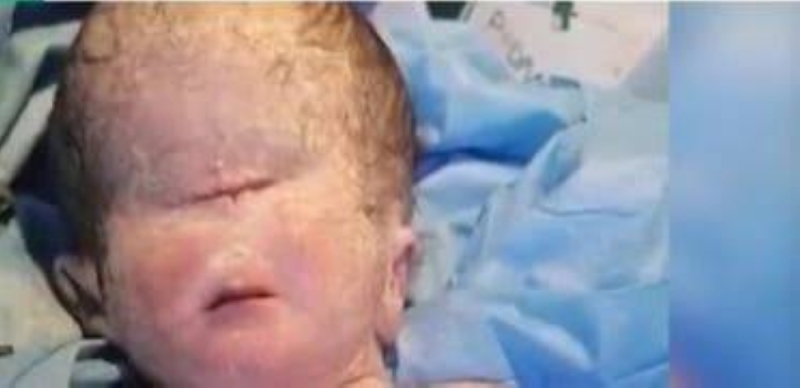 ولادة طفل بعين واحدة في العراق.. وطبيبان يذكران 3 أسباب