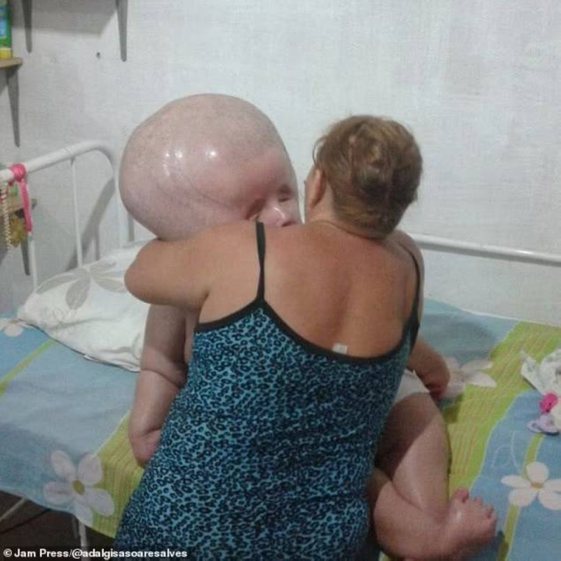 شاهد .. امرأة تعاني من مرض نادر يتسبب في تضخم حجم رأسها 3 أضعاف