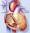 تأثير الحمل على قلب الحامل مريضة القلب
