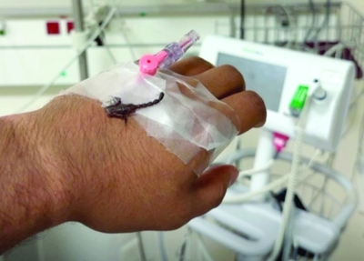 يد المواطن المتورمة... تحمل إحدى العقربين بعد قتلها