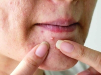 6 أسباب لظهور «حبوب الفم»