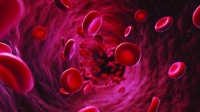 مرضى سرطان الدم أكثر عرضة لـ «كوفيد 19»
