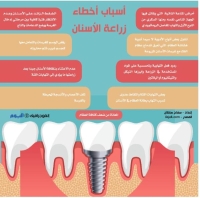 أسباب أخطاء زراعة الأسنان