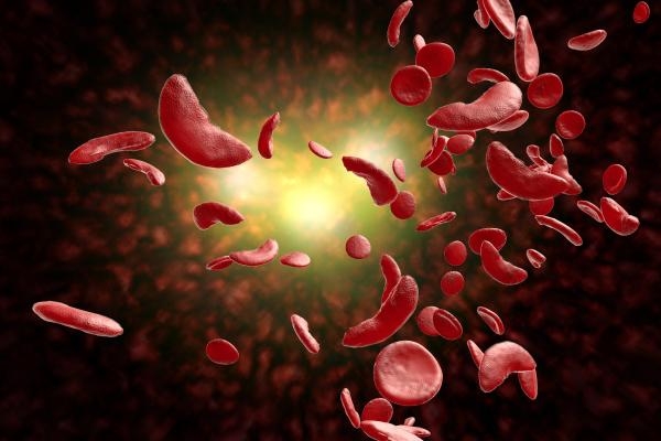 مرضى فقر الدم المنجلي أكثر عرضة للإصابة بكورونا