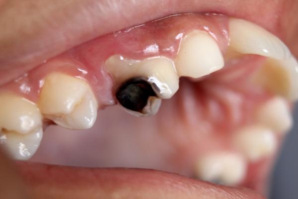 إهمال علاج تسوس الأسنان يتسبب في مضاعفات خطيرة- مشاع إبداعي