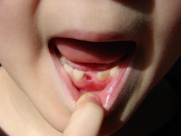 فقدان الأسنان أحد مضاعفات التسوس- مشاع إبداعي