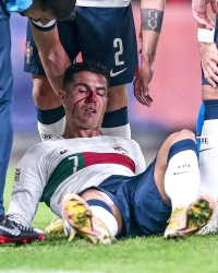 إصابة دموية لكريستيانو رونالدو في مباراة البرتغال أمام التشيك