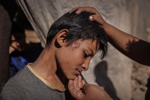 طفل باحد المخيمات يعاني من أعراض الكوليرا التي تفشت بسوريا (د ب أ)