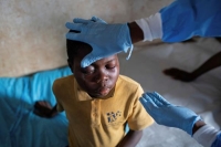 فحص عينيّ طفل يشتبه في إصابته بجدري القرود في الكونغو الديمقراطية - رويترز