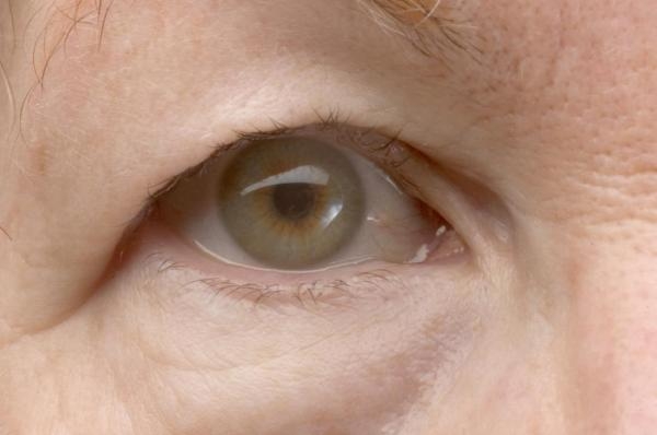 مرض تدلي جفن العين .. أسبابه وأعراضه وكيفية العلاج