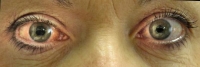 داء العيون "الزرقاء".. ما تريد معرفته عن مرض الجلوكوما 