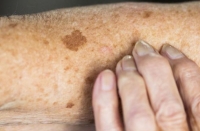 تظهر عند 55% من المرضى.. بقع ملونة على الجلد تشير إلى إصابتك السكري
