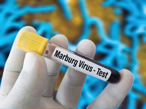 فيروس ماربورج معد ومميت - أرشيفية اليوم