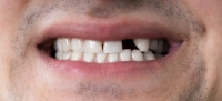 العقار يمنح الأمل للبالغين الذين فقدوا أسنانهم بسبب التسوس - موقع Pembroke Dental Clinics