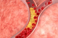 زيادة مستويات الكوليسترول في الدم تسبب أزمات صحية- مشاع إبداعي