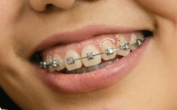 بروز الأسنان غالبًا ما يكون مرتبط بوصمات اجتماعية - مشاع إبداعي