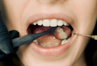إليكم أهم النصائح للتعامل مع الأسنان الحساسة ونزيف اللثة