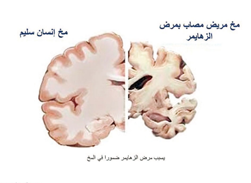 لقطة تبين الفرق بين مخ انسان سليم وآخر مصاب بالزهايمر