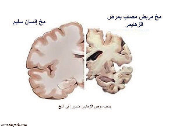  لقطة توضح تعرض مخ إنسان للضمور بسبب الزهايمر وآخر سليم