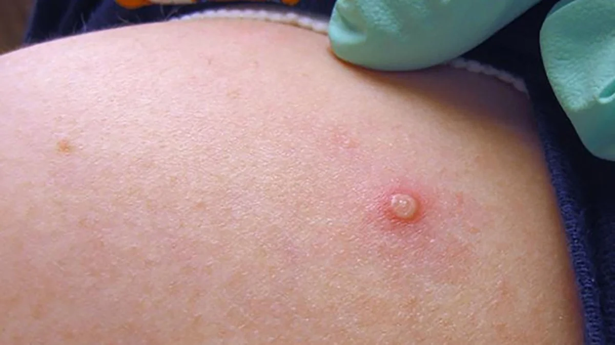Guidelines for reporting and handling monkeypox