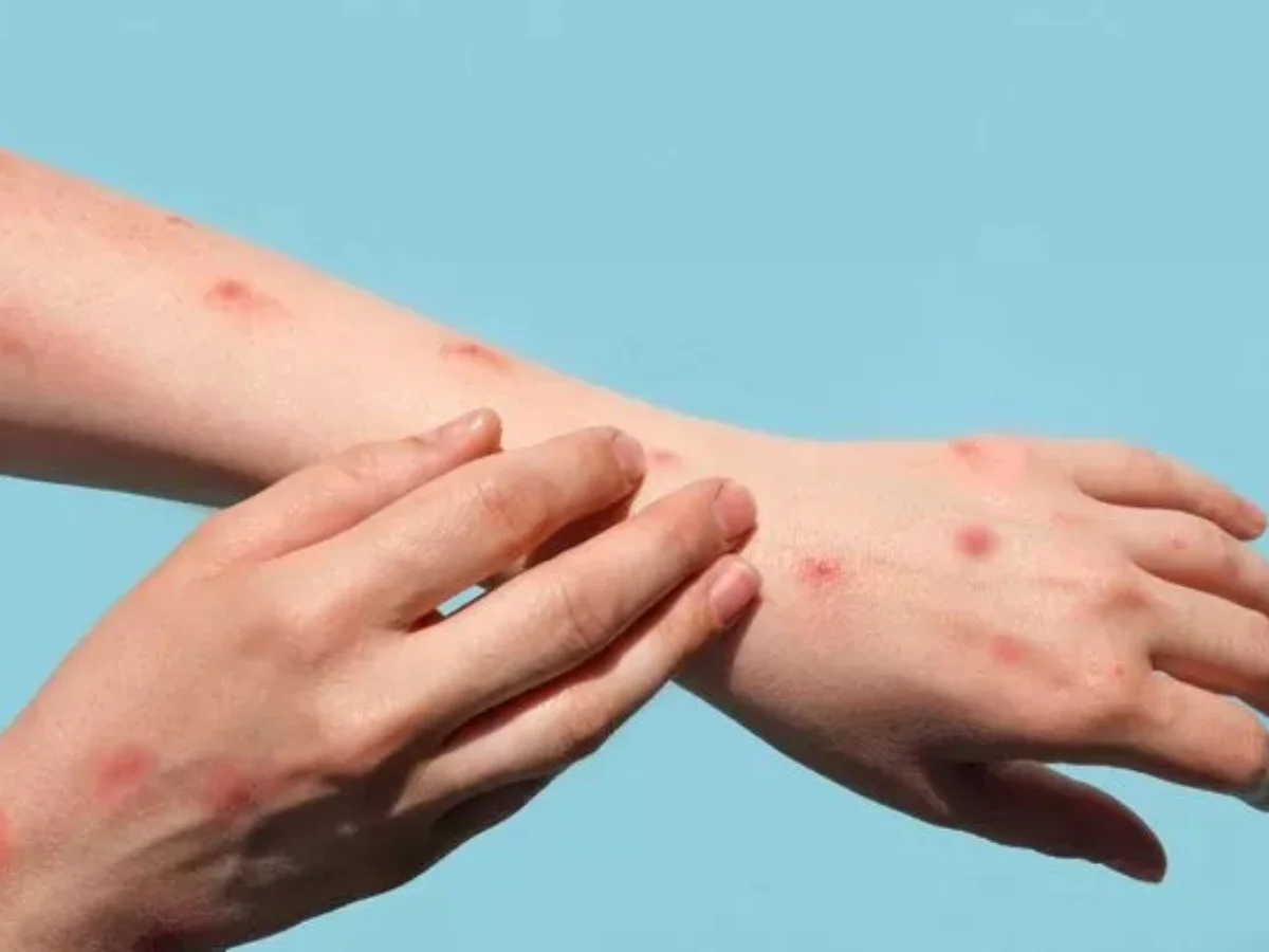 6 suspected monkeypox cases in Kuwait test negative