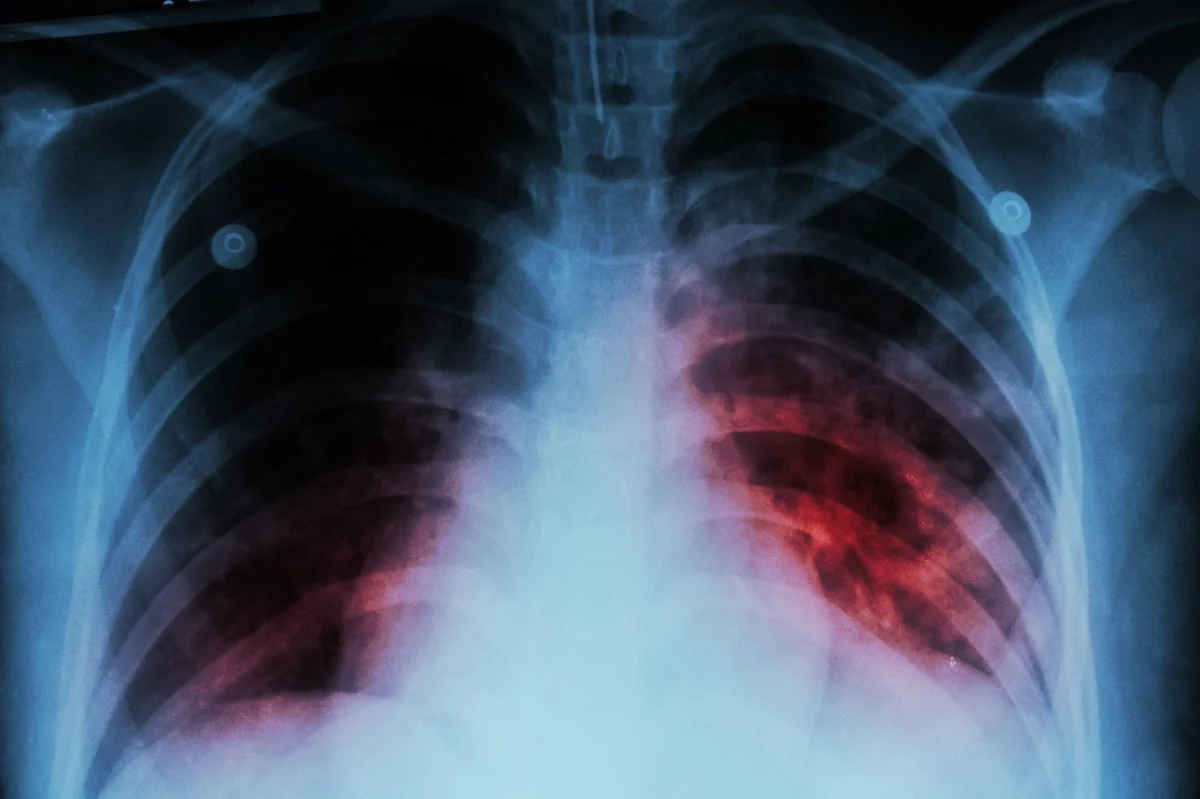 Tuberculosis becomes leading cause of infectious disease deaths in 2023: WHO