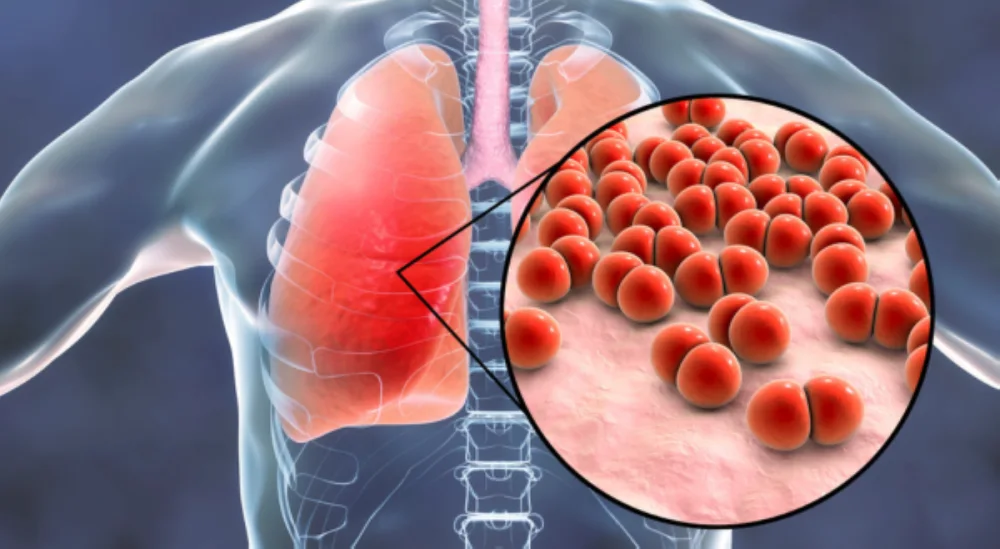 Pneumonia, pang-apat sa mga pangunahing sakit na ikinamamatay ng mga Pinoy—PHAP