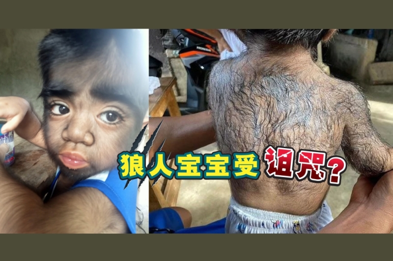 最近,菲律宾一名2岁男童因毛发生长异常,全身甚至满脸毛发的看起来酷似“狼人”,引起各大媒体关注。-摘自网络,精彩大马制图- 最近,菲律宾一名2岁男童因毛发生长异常,全身甚至满脸毛发的看起来酷似“狼人”,引起各大媒体关注。-摘自网络,精彩大马制图-