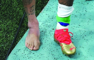 Picture of the swollen ankle of Brazil’s Neymar taken as he leaves the field at the end of the Group G match against Serbia at the Lusail Stadium on Thursday. (AFP)