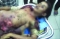 






طفل من ضحايا ألغام الحوثي بالحديدة                               (مكة)